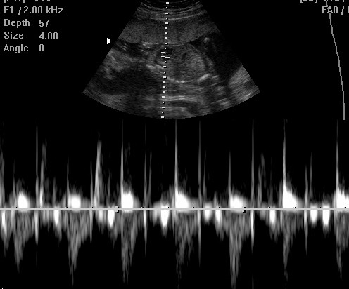 "Prince" Or "Princess" Gender Ultrasound Determination Reveal Sonogram